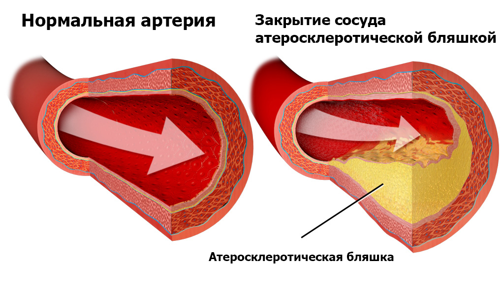 Окклюзирующие заболеваний артерий фото