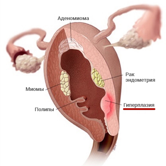 Гиперплазия эндометрия фото