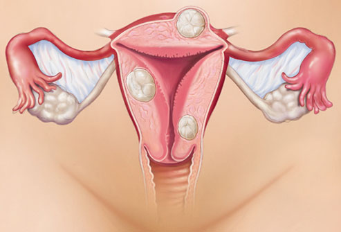 миома матки и эндометриоз лечение