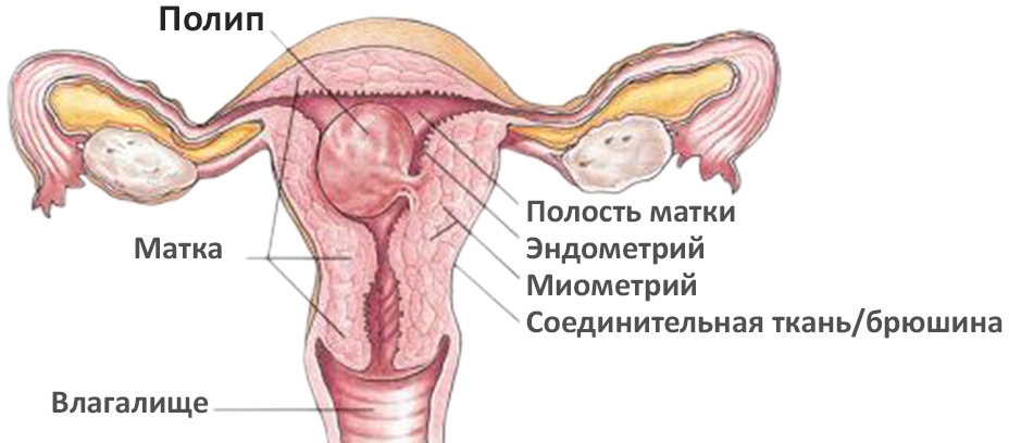 Лечение полипов эндометрия фото