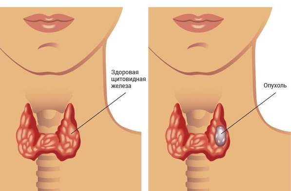 Предраки и опухоли щитовидной железы фото