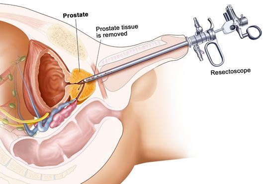 Prosztata adenoma túra transzuretrális rezekció - A prosztata transzuretrális reszekciója