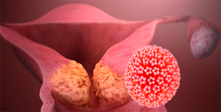 papillomavírus és vulva rák