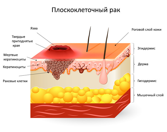Плоскоклеточный рак кожи (болезнь Боуэна)